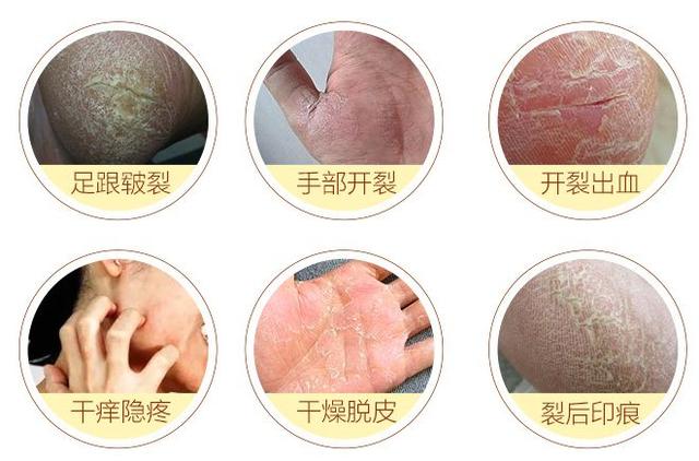 手指脱皮开裂怎么办
