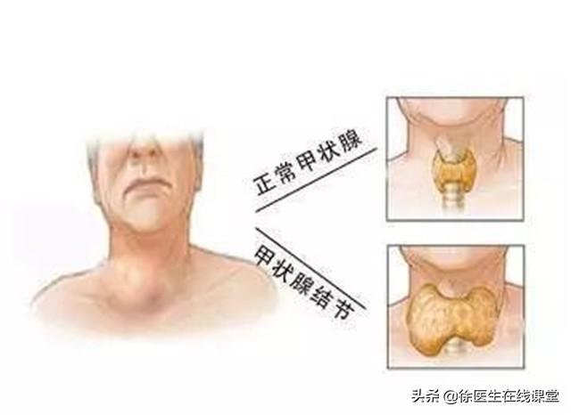 双侧甲状腺多发胶质结节 双侧甲状腺多发胶质结节2类