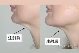 咬肌大的姐妹们这样瘦脸图片