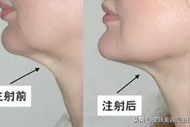 咬肌大的姐妹们这样瘦脸图片