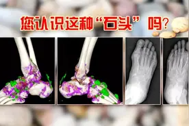 化痛风降尿酸，这种溶解痛躲不开！太多人因此放弃治疗，很可惜图片