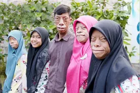 男子全家患罕见怪病，长相酷似动物，至今为止没有任何治疗手段图片