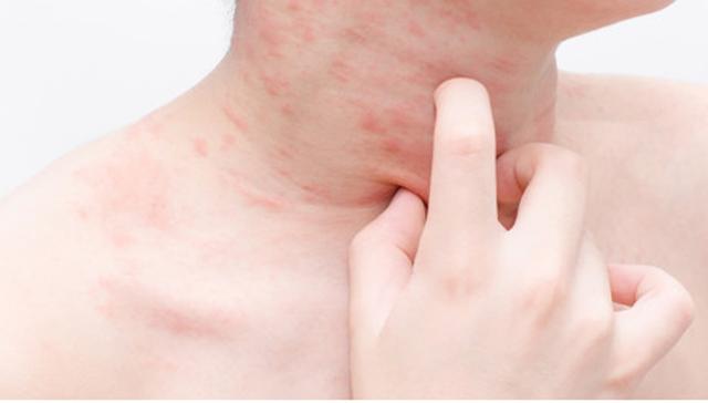 海鲜过敏会有鸡皮疙瘩