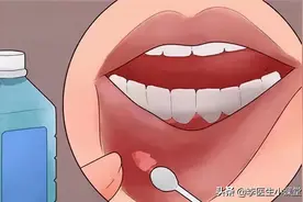 有一种痛，叫口腔溃疡：补充维C不顶用，用上3类药物更靠谱图片