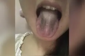 湖北25岁女孩舌头“突然发黑” 医生：肾太虚了，身体完全透支！图片
