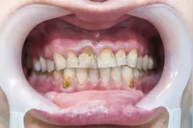 日本又闹事了！河流地下水有毒！氟化物和牙齿之间相爱相杀图片