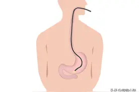 怎么做胃镜？做胃镜有讲究，你知道这些注意事项吗？图片