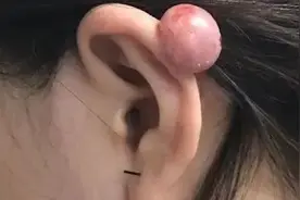 这种人别随便打耳洞！有人一口气打了4个，打出2个“肉疙瘩”图片