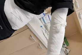 女演员发文曝拔火罐被深二度烧伤，专家：注意事项要谨记图片
