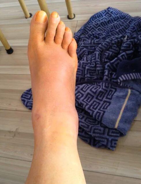 崴脚没肿但是疼怎么办