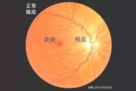 【患者疑问】“医生！我眼睛里长黄斑了？！”图片