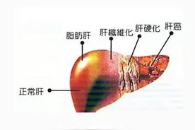 3个坏习惯最伤肝，医生：肝功能异常有9个表现，要及时检查图片