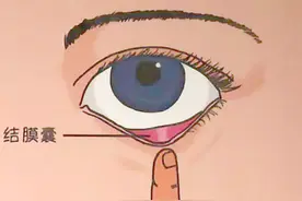眼药水应滴到眼睛里的哪个部位，你知道吗？图片