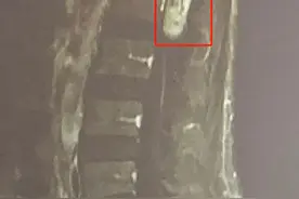腰腿痛错当“腰椎间盘突出”治！不料是腰椎里长瘤作怪图片