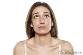 国际痘痘分级法？脸上的痘痘究竟在危险等级是多少？快看这儿图片