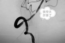 济宁市中西医结合医院脑病科成功开展颅内大血管狭窄支架植入治疗图片