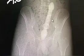 灯泡、哑铃、活泥鳅，医生呼吁：别再往肛门里塞东西了图片