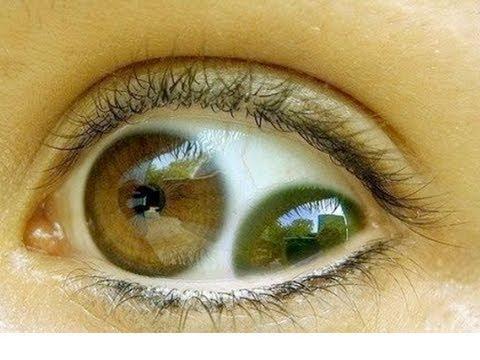 虹膜异色症有什么危害 虹膜异色症有什么危害和后果(图7)