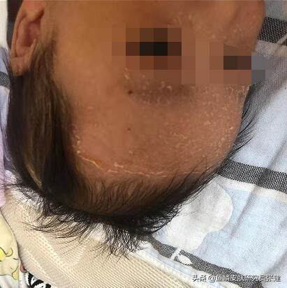 凡士林可以去鱼鳞皮肤吗