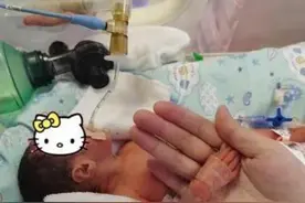胎龄6个多月的早产儿闯过几道生死关，出生时只有成人手掌大的、皮肤如胶冻图片