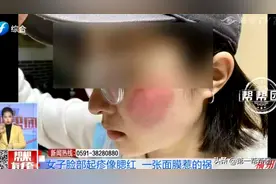 女大学生使用网红面膜后，脸颊出现大片红斑，​刺痛脱皮图片