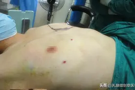 男性乳房肥大怎么办？图片