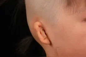 残耳组织的多少与耳再造手术效果的关系图片