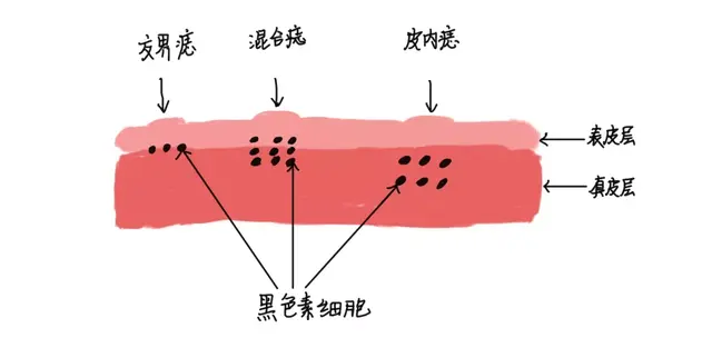 混合痣表皮角化不全