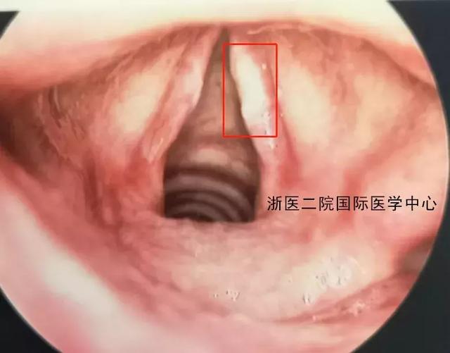 双侧声带鳞状上皮及角化物