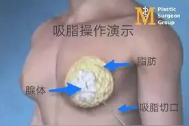 小伙儿腰围88胸围145太尴尬 哈医大一院乳腺外科无痕手术解决男性乳房发育困扰图片