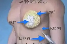 小伙儿腰围88胸围145太尴尬 哈医大一院乳腺外科无痕手术解决男性乳房发育困扰图片