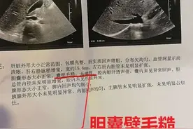 查出胆囊壁毛糙、胆囊壁增厚该怎么办？图片