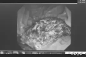 福州12岁女孩腹中取出一斤多头发，背后原因竟是患上异食癖？图片