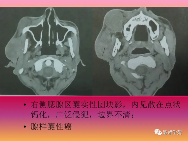 腮腺角化型鳞癌