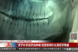 细思极恐！女子补牙后牙齿肿痛，检查发现3毫米针头落在牙根里图片