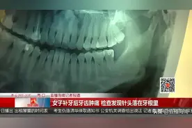 细思极恐！女子补牙后牙齿肿痛，检查发现3毫米针头落在牙根里图片