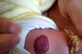 不同类型的血管瘤应该怎么准确判断图片
