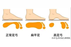 扁平足究竟是哪里不足！图片