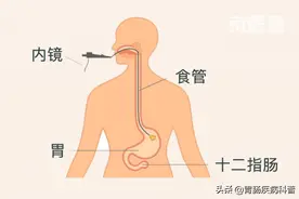3分钟看懂——胃镜报告图片