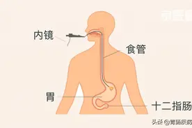 3分钟看懂——胃镜报告图片