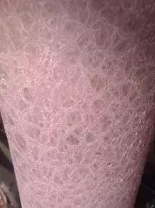 鱼鳞病流汗吗 鱼鳞病流汗吗