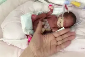 山东“最轻新生儿”100天了！出生体重不到一斤​，还没成人手掌大图片