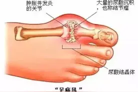 痛风疼痛红肿怎么办？下面五种方法教你快速止痛消肿图片
