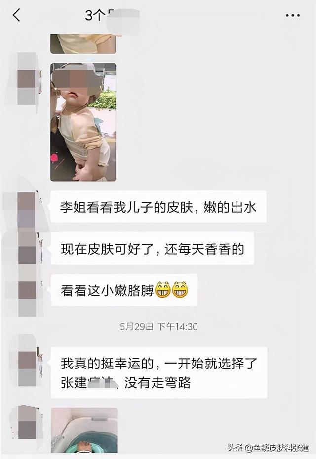 丈夫有鱼鳞病担心遗传