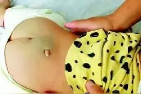 警惕！屁股上方长尾巴、毛发，是返祖？极可能是脊髓拴系综合征！图片