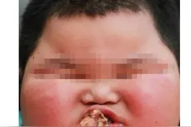 4岁小男孩120斤重，因为太胖医生预言，他很有可能活不过20岁图片
