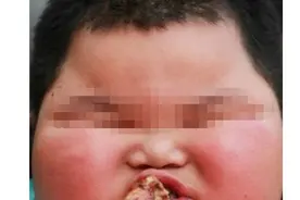 4岁小男孩120斤重，因为太胖医生预言，他很有可能活不过20岁图片
