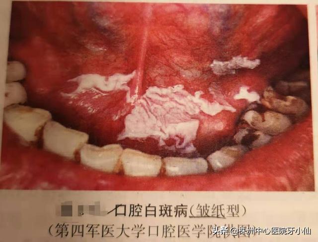 口腔粘膜角化是什么病