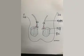 手术日志31：管道疏通工！输精管结扎手术后复杂的复通疏通手术图片