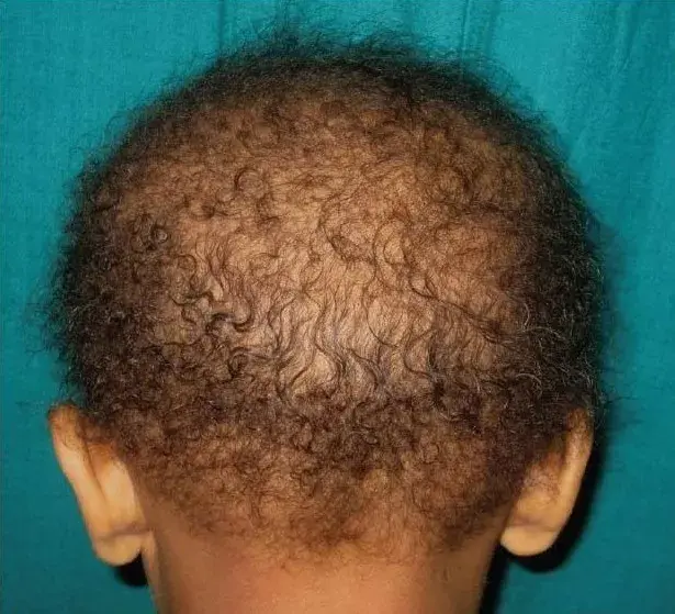 得了毛襄角化症的人能结婚吗